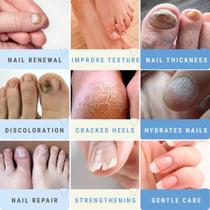 Urea 50% Nail Gel