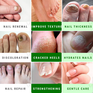 Urea 50% Nail Gel