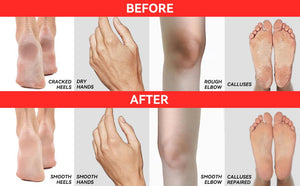 CLEAR Urea Cream 40 (4oz) – Intensive Skin Repair