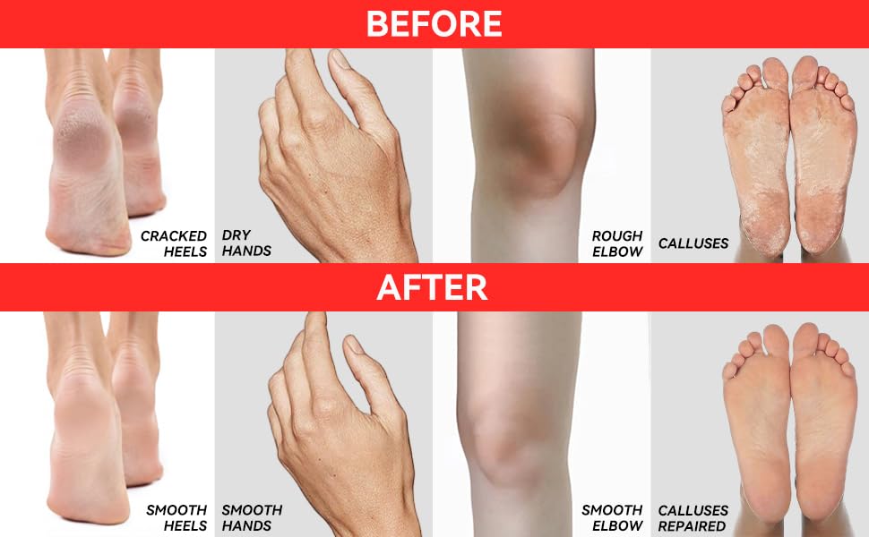 CLEAR Urea Cream 40 (4oz) – Intensive Skin Repair